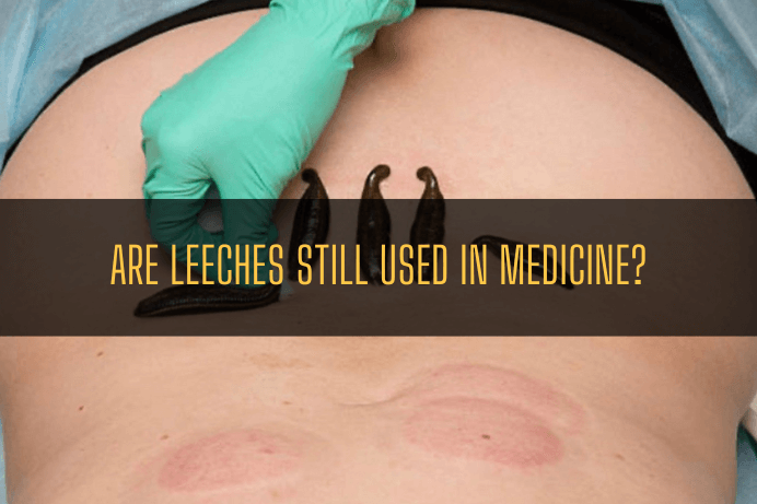 Are Leeches still used in Medicine